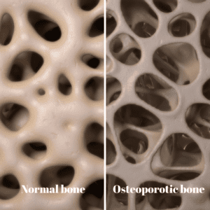 Normal vs Osteoporotic bone image