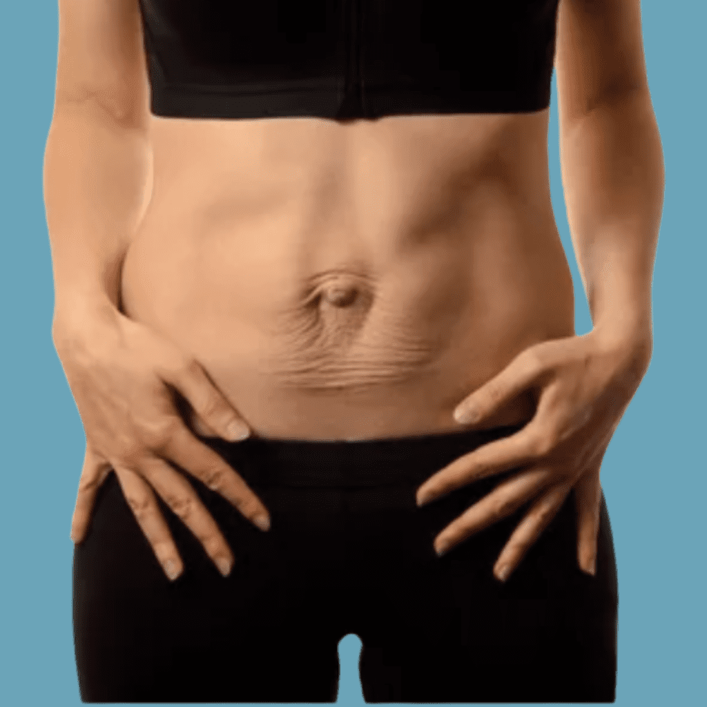 Diastasis Recti Essendon