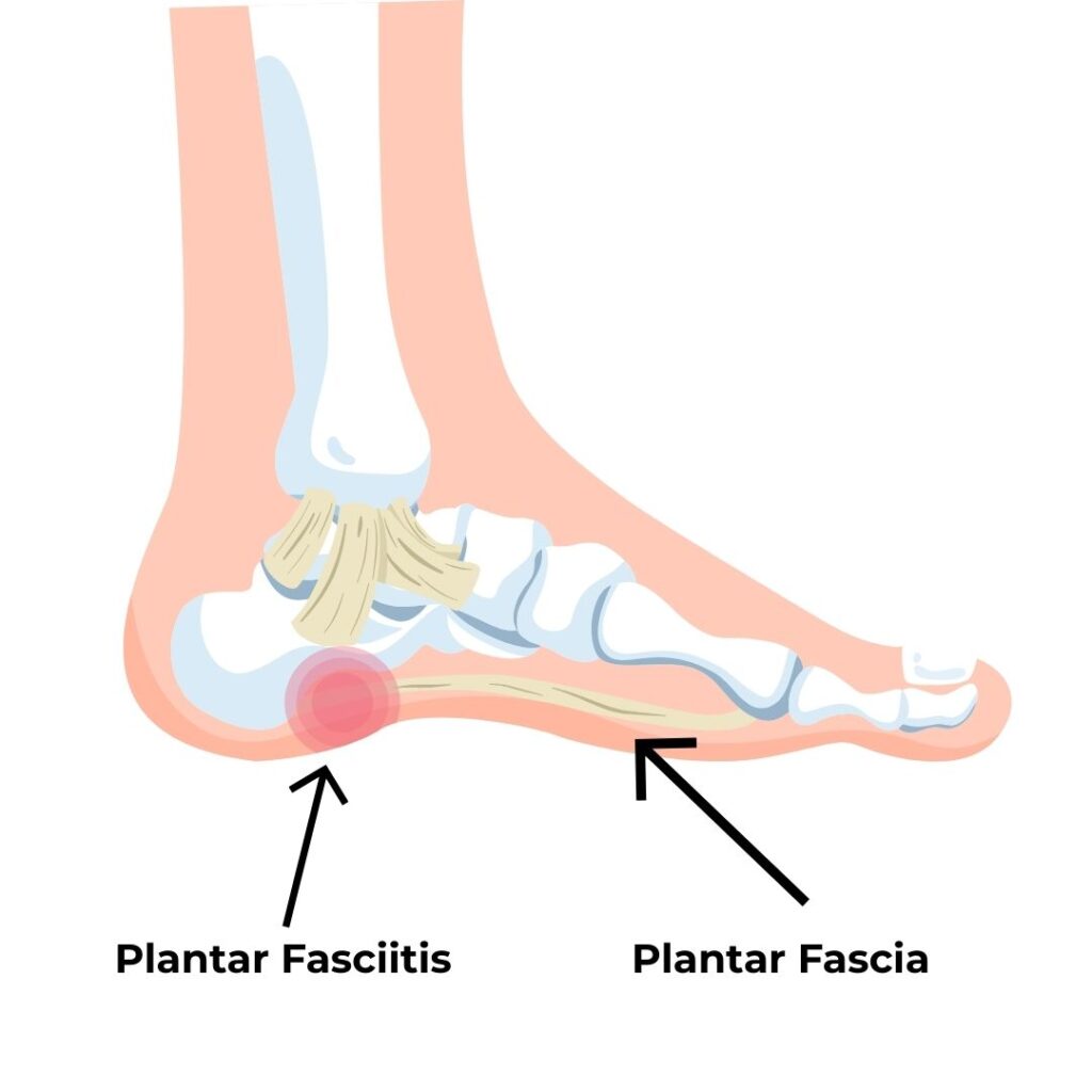 Plantar Fascia Image Hyrox